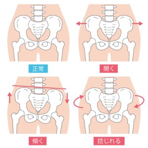 明石市大久保で骨盤矯正で整骨院おお探しなら、あゆむ鍼灸接骨院へ